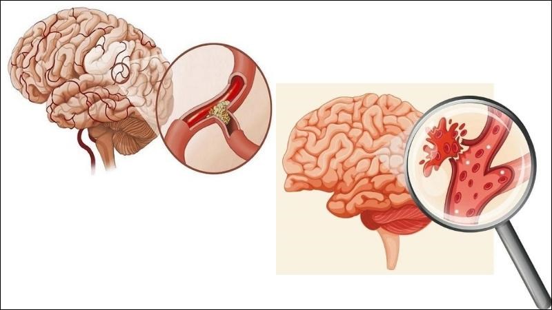 Hai nguyên nhân chính gây đột quỵ là tắc động mạch và vỡ mạch máu